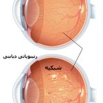 درمان آسیب چشم دیابتی‌ها با هوش مصنوعی